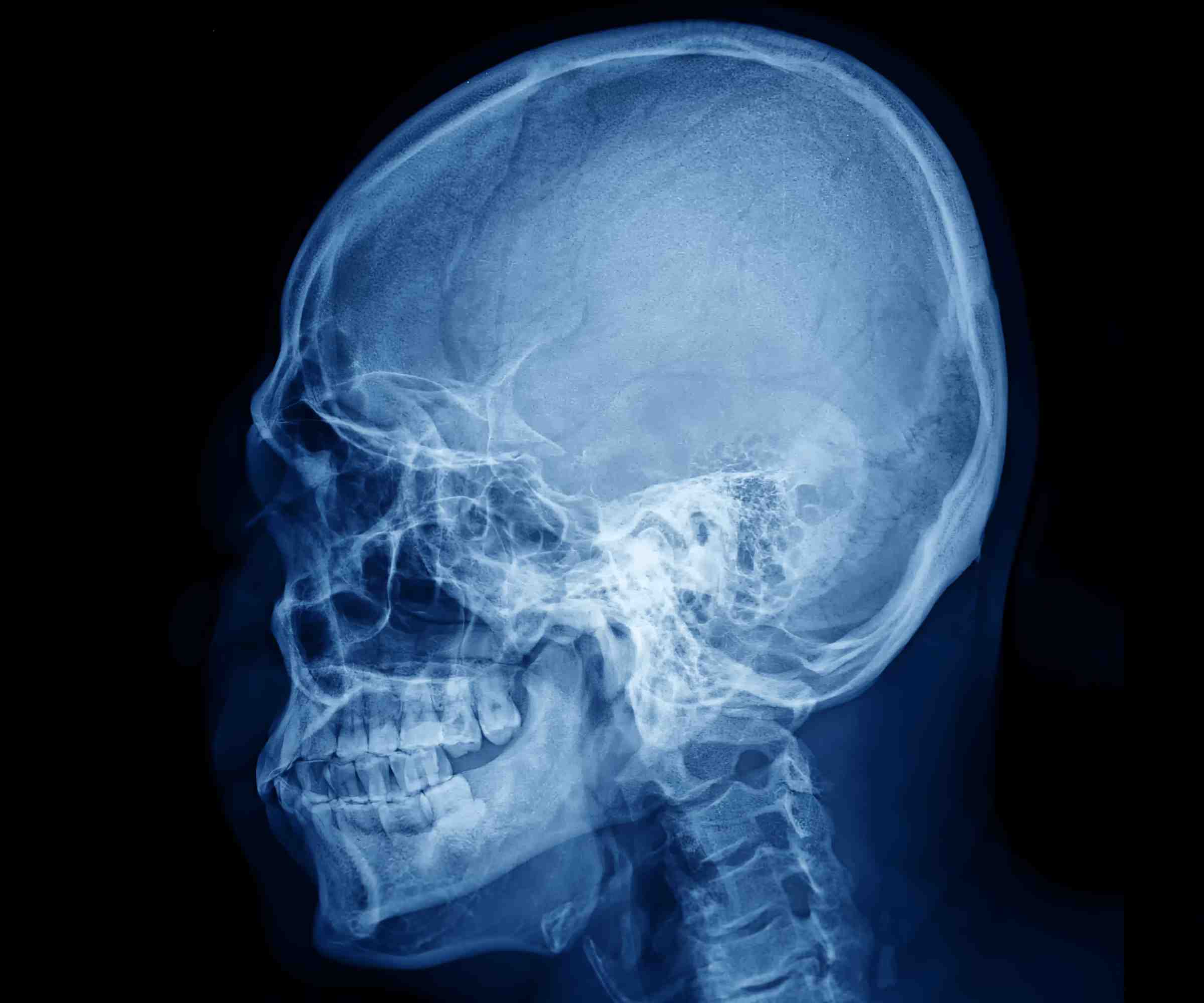 Sefalometrik Röntgen Nedir? Sefalometrik Röntgen ve Standart Röntgen Arasındaki Farklar