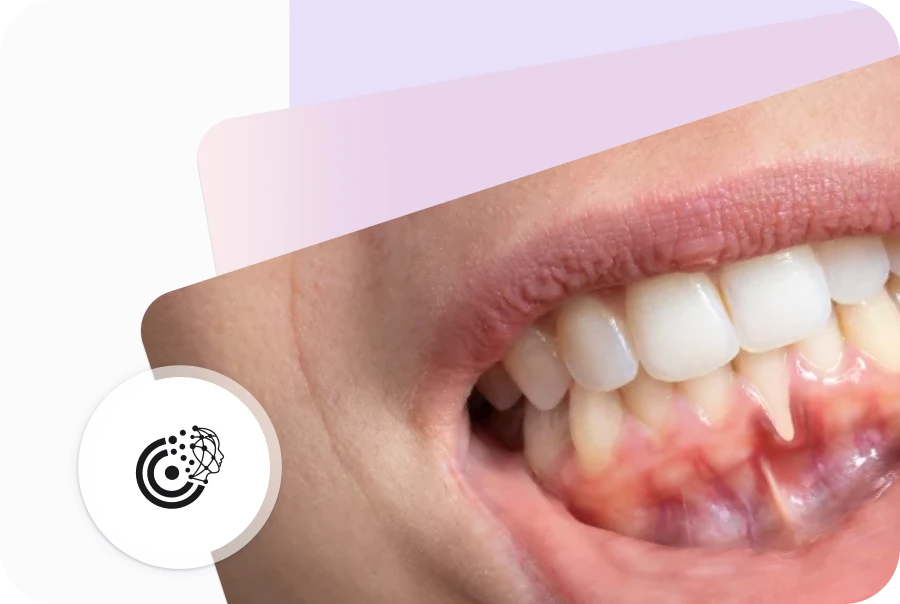 Diş Eti Çekilmesi Nedir? Nedenleri, Tedavisi ve Yapay Zeka ile Teşhis