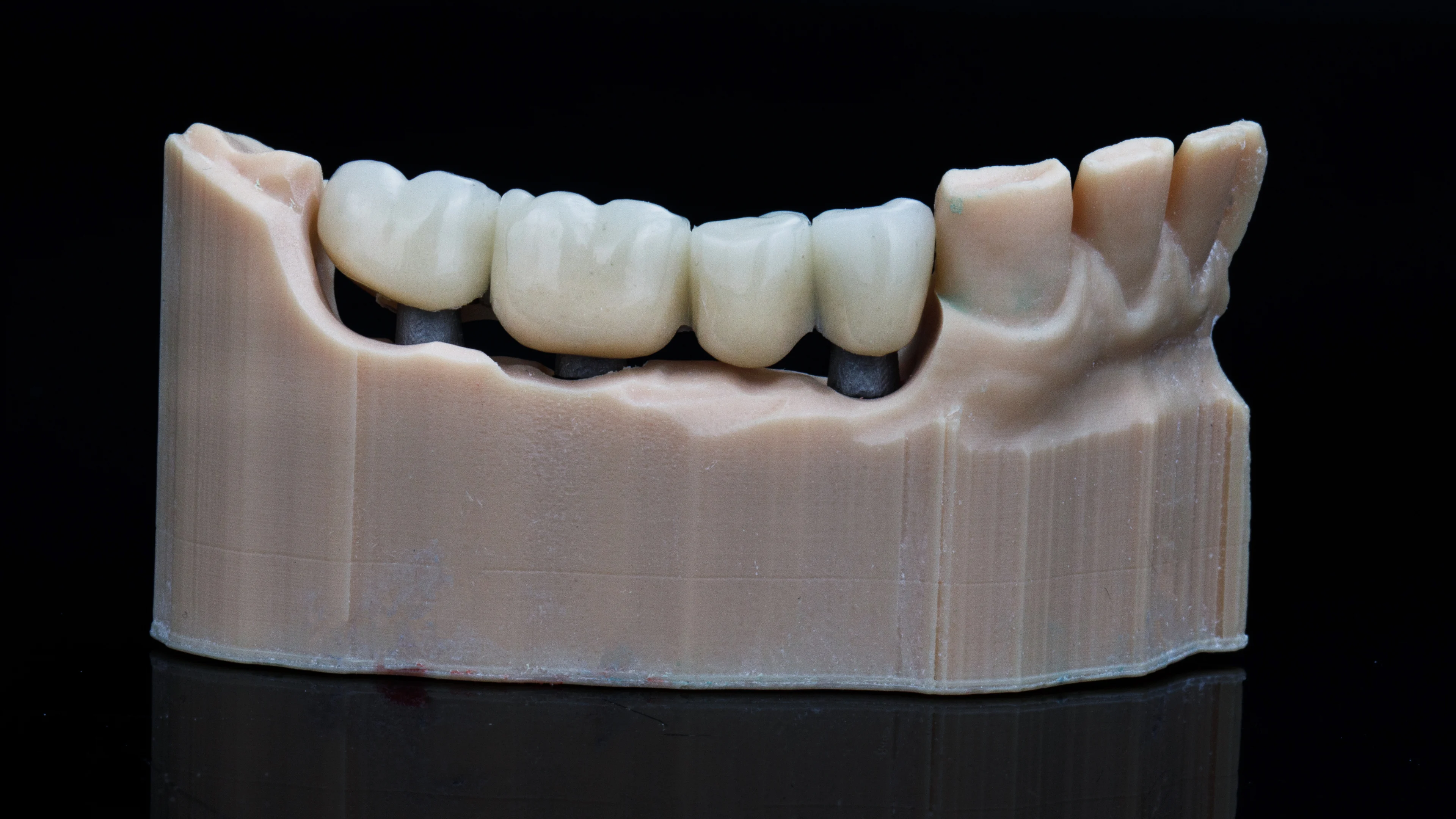 AI ile üretilen diş kronu 3D modeli