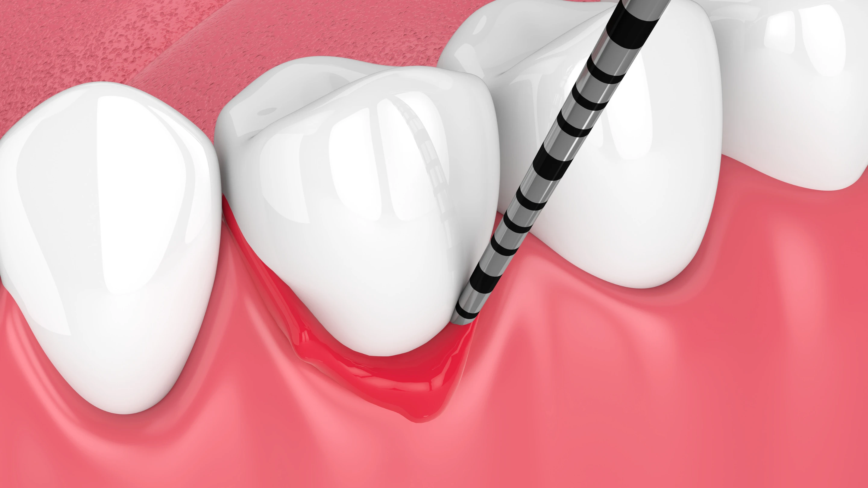 Receding gums can be treated with early diagnosis