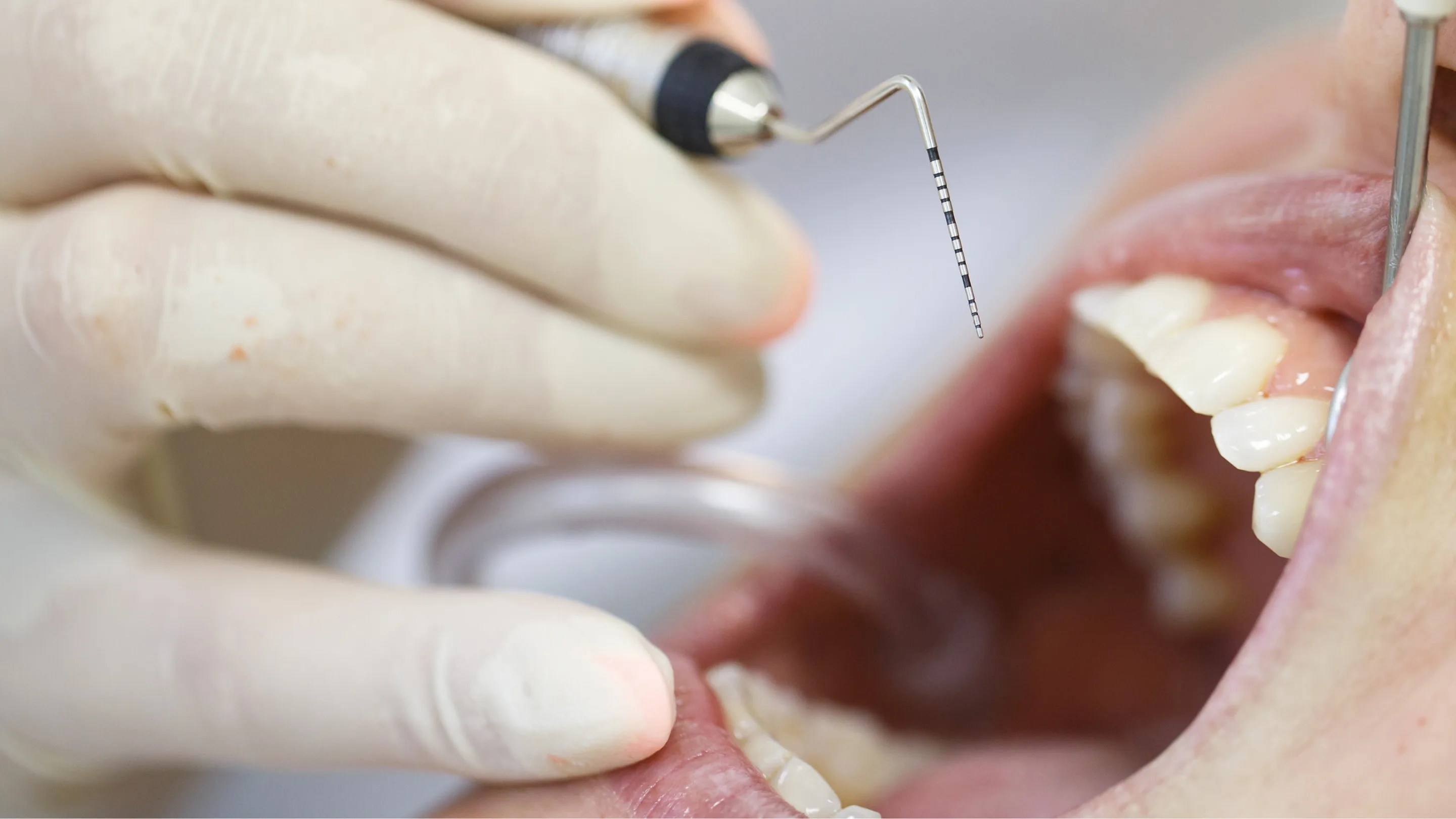 Surgical and non-surgical treatments fix receding gums effectively