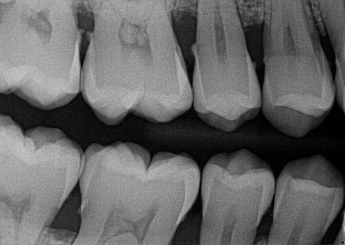 bitewing dental x ray