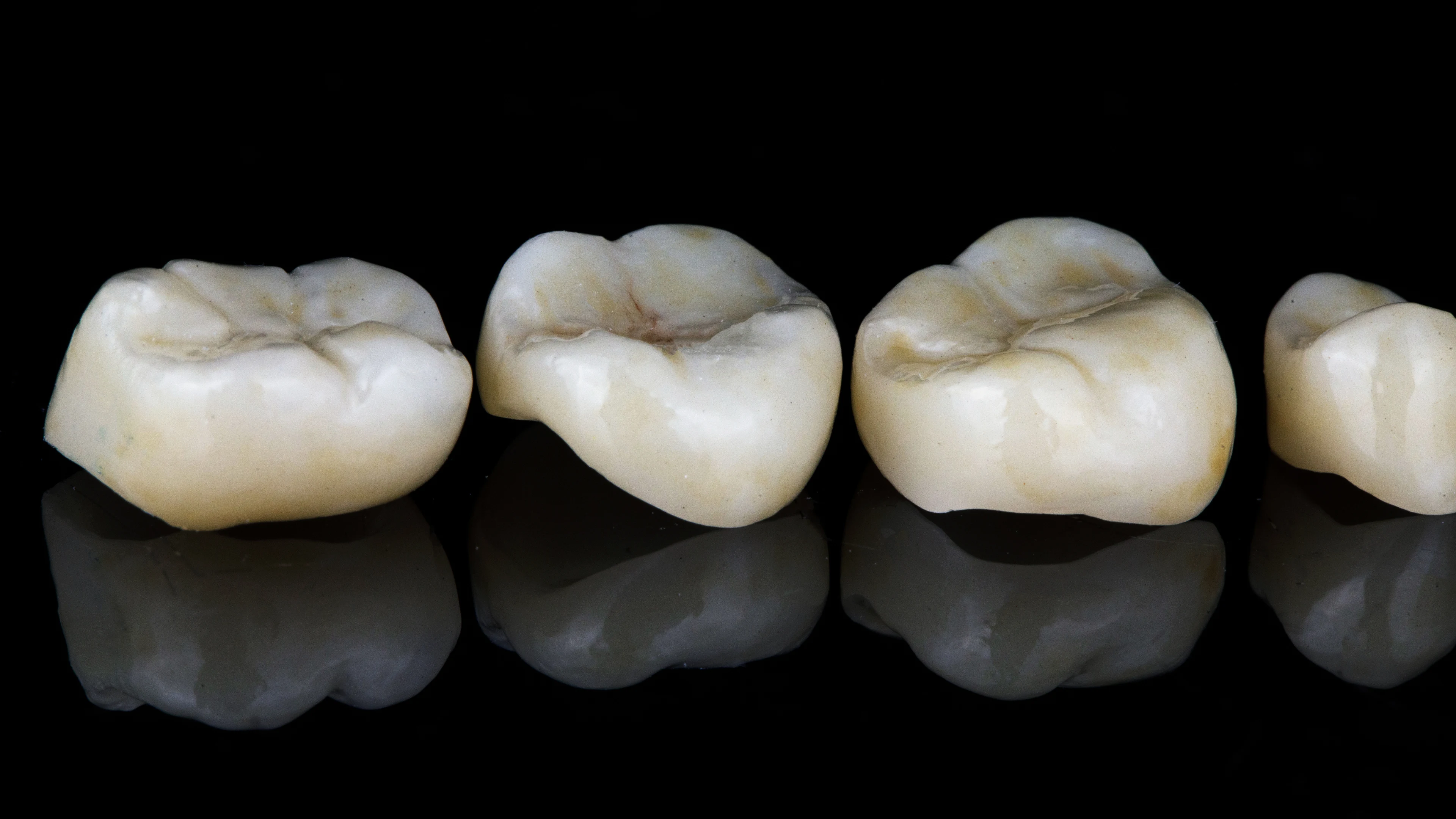Digital dental crowns provide functional results by offering high precision
