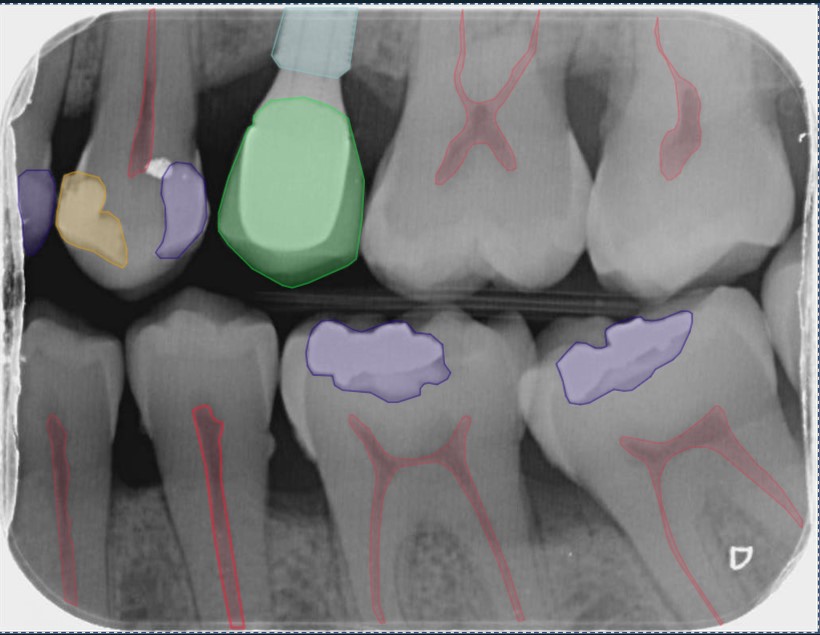 CranioCatch Dental X-Ray Bitewing Analysis