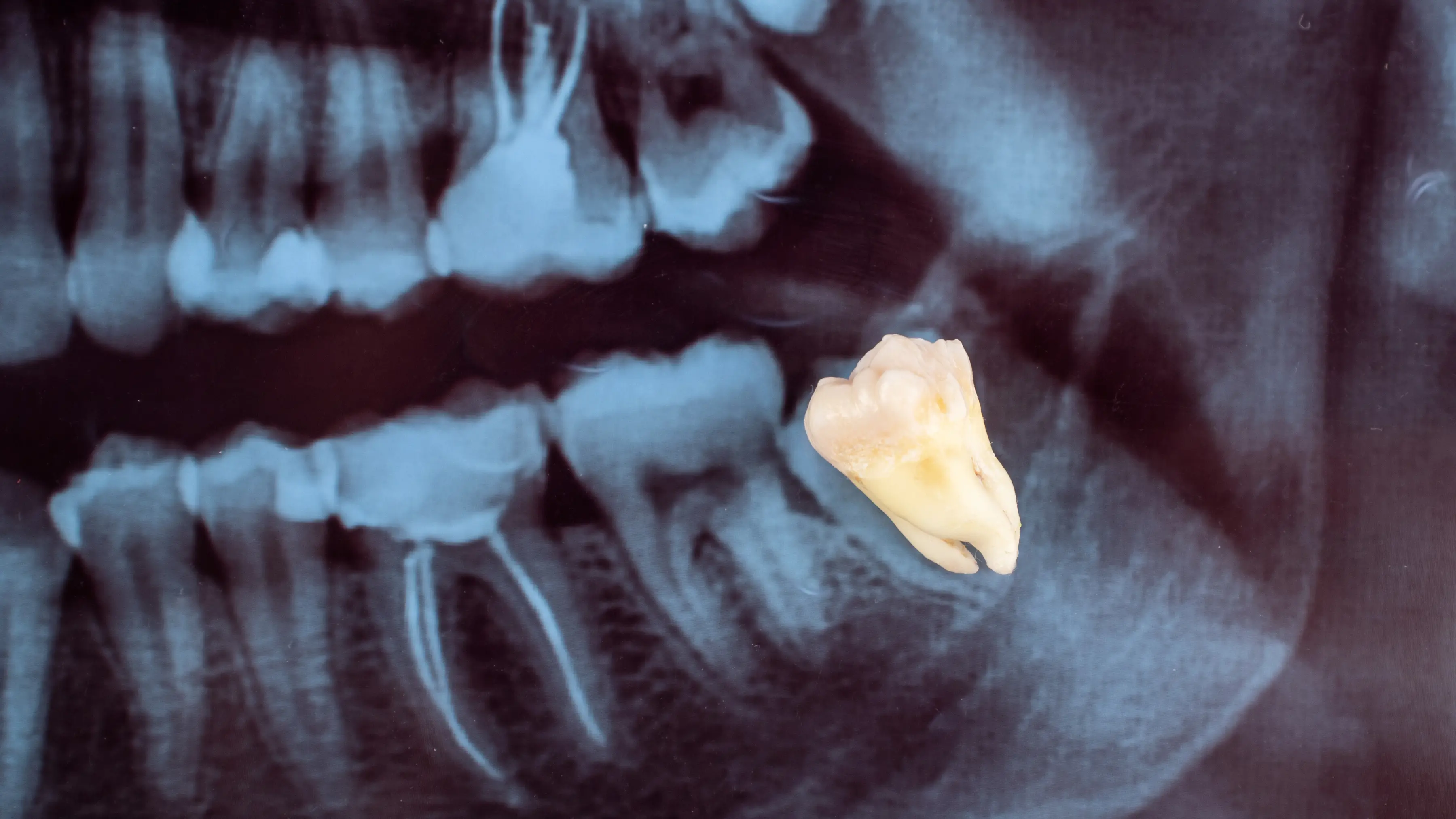swollen gum wisdom tooth