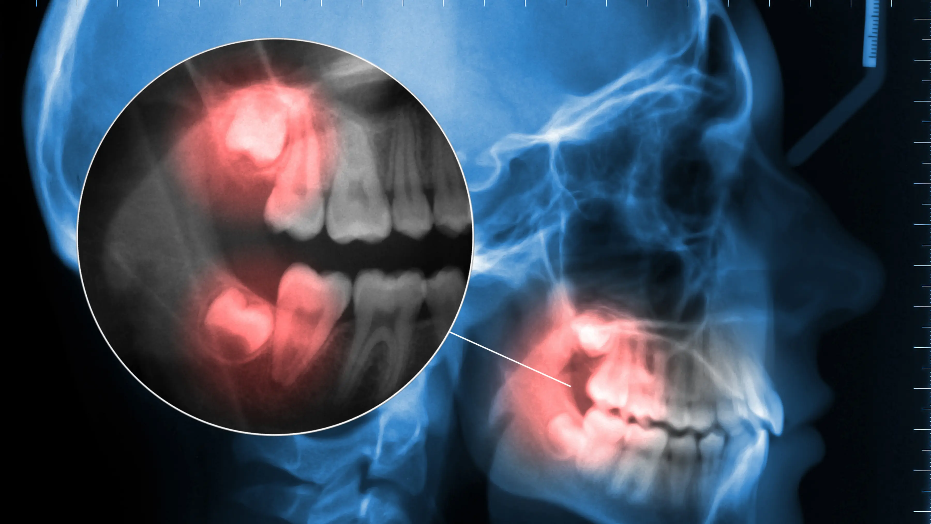 early stage wisdom tooth infection