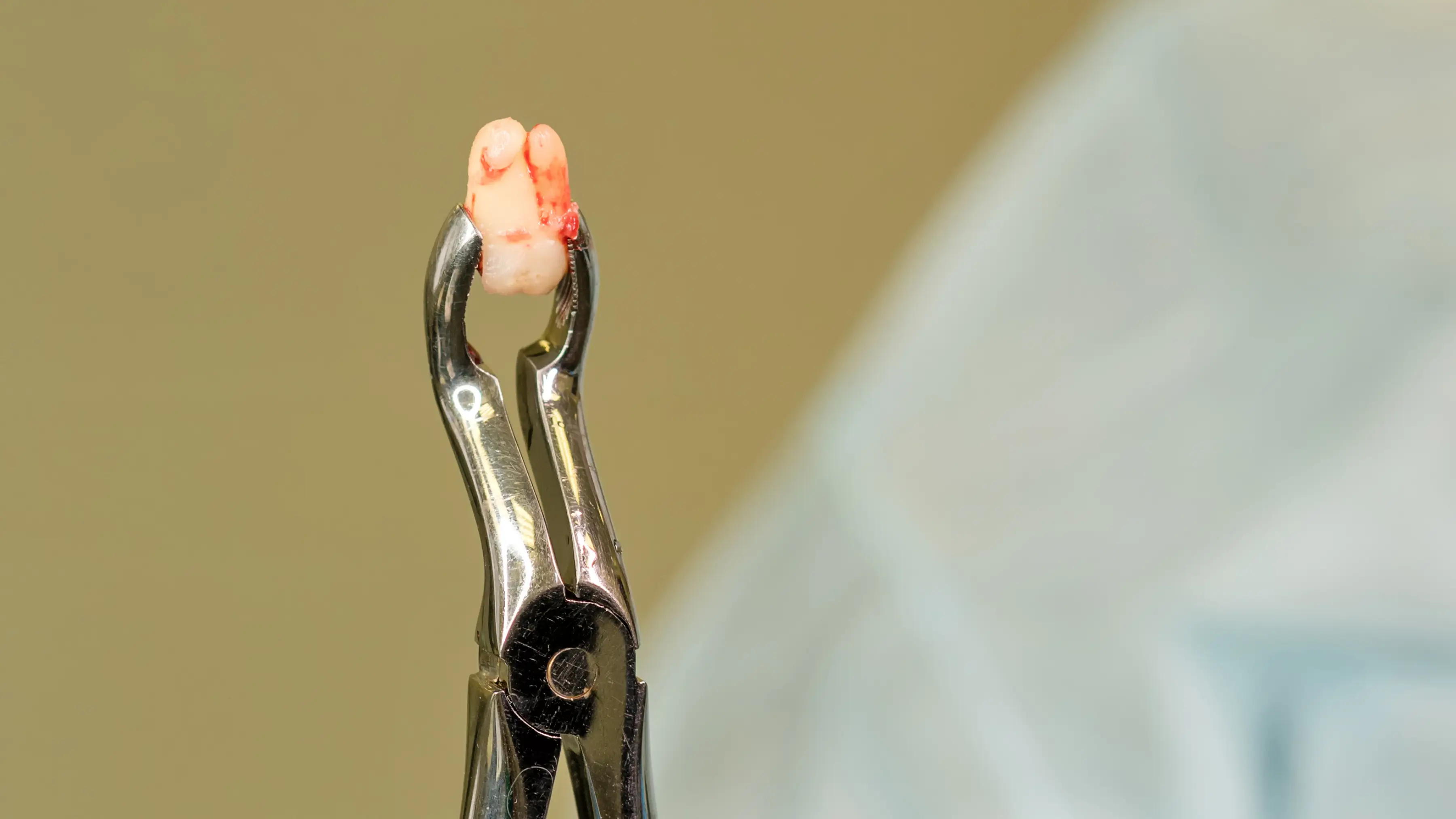 wisdom tooth removal