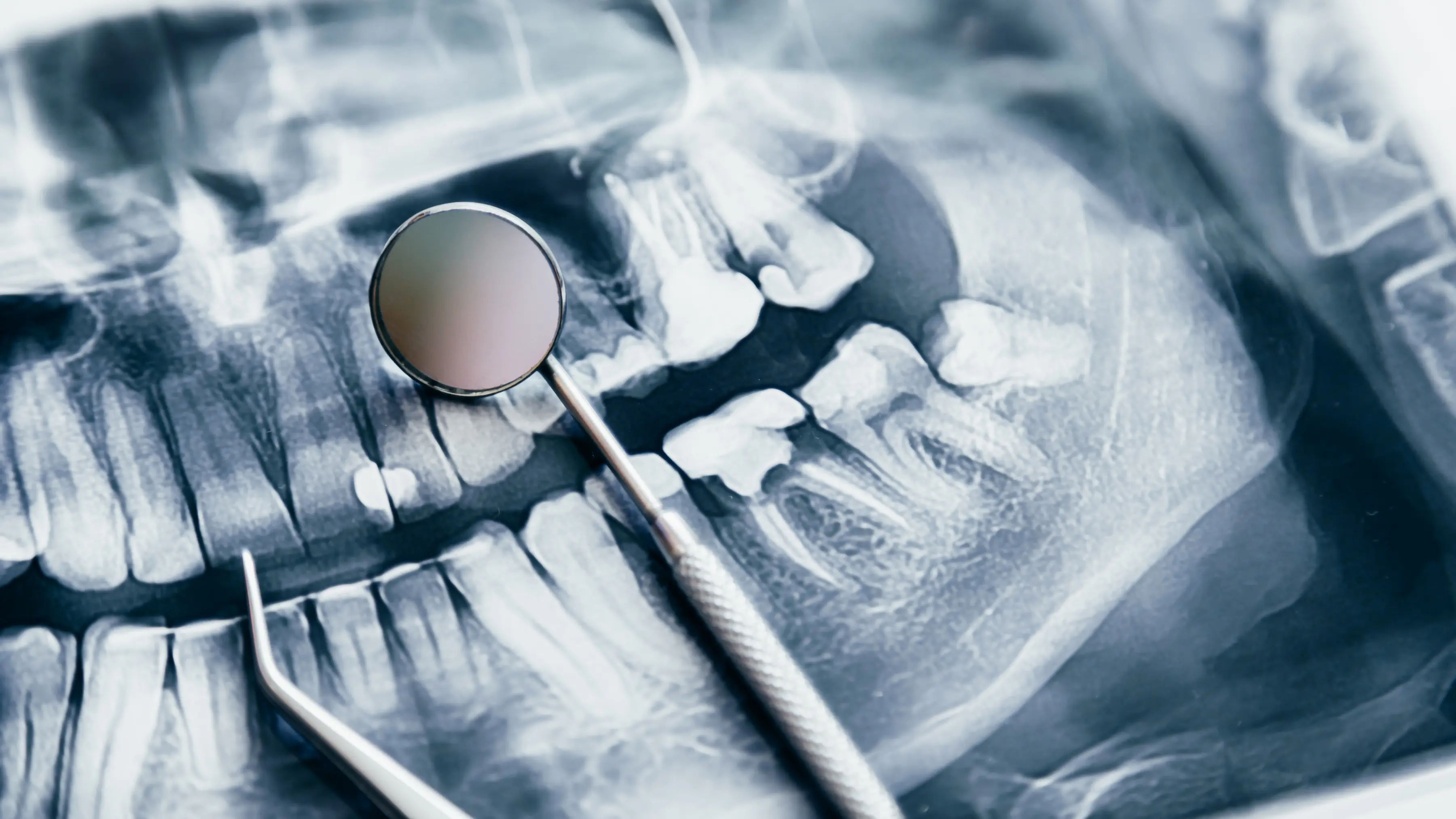 wisdom tooth
