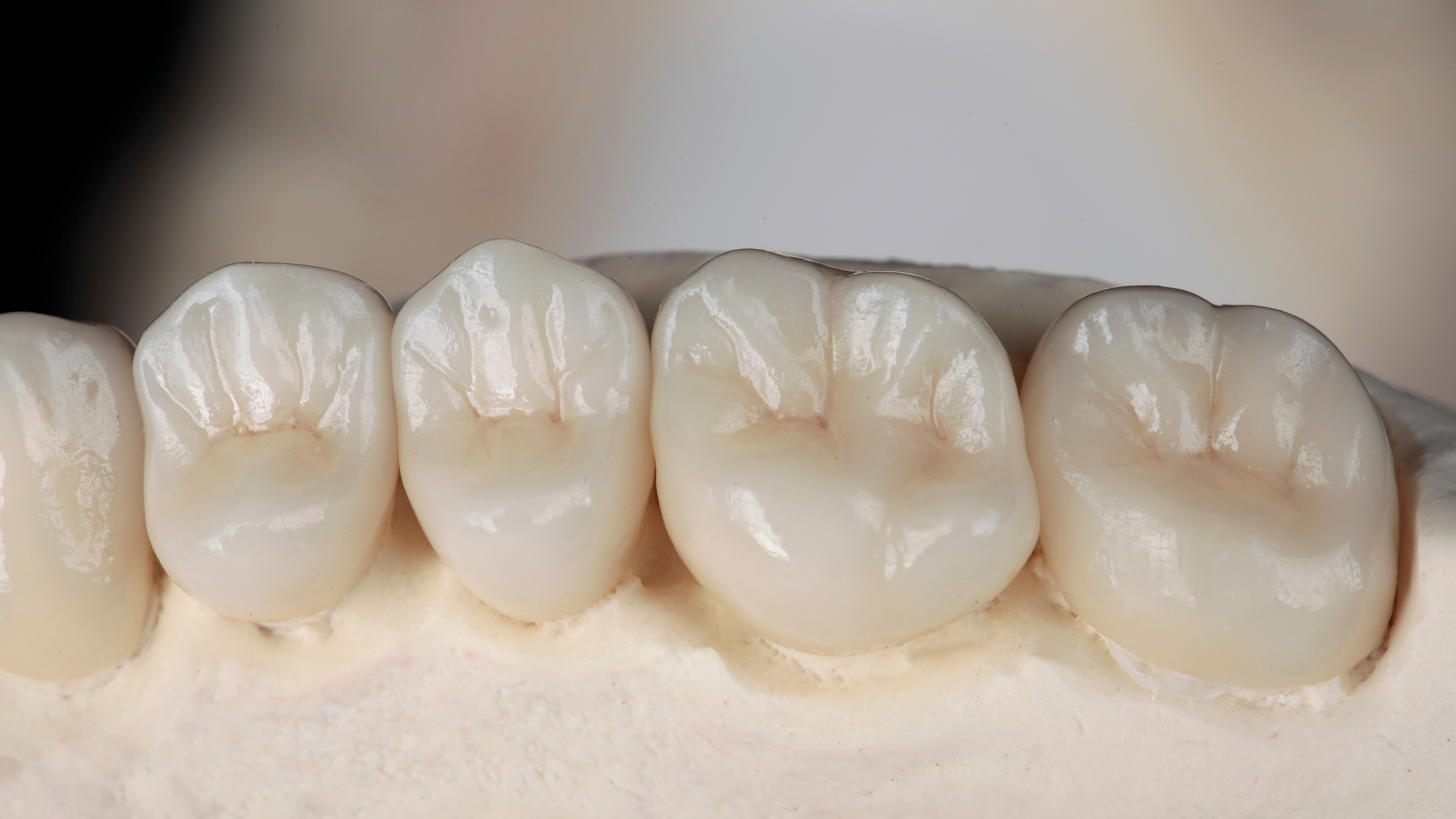 A close-up of a bridge tooth inside a mouth, highlighting a dental bridge front tooth, illustrating what a bridge tooth is and how tooth bridges or bridges for a front tooth function in dental care.