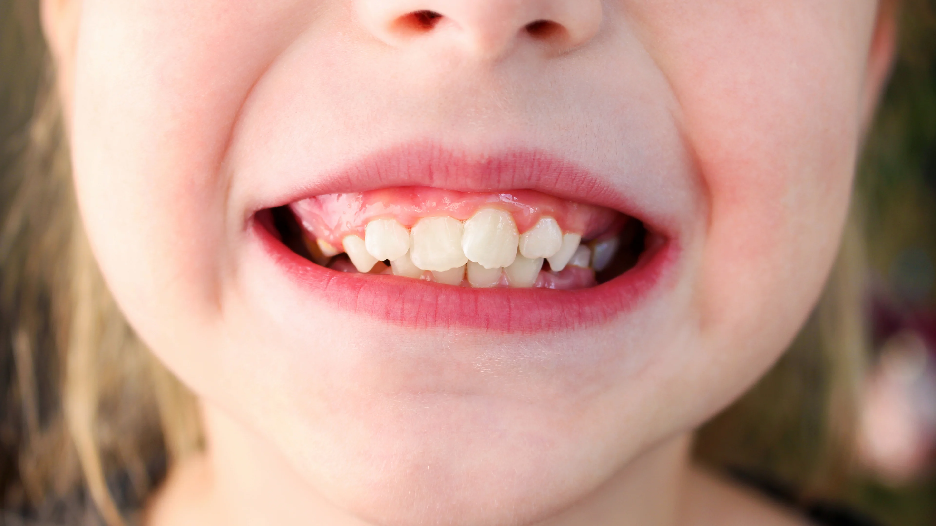 Child with a visible snaggle tooth