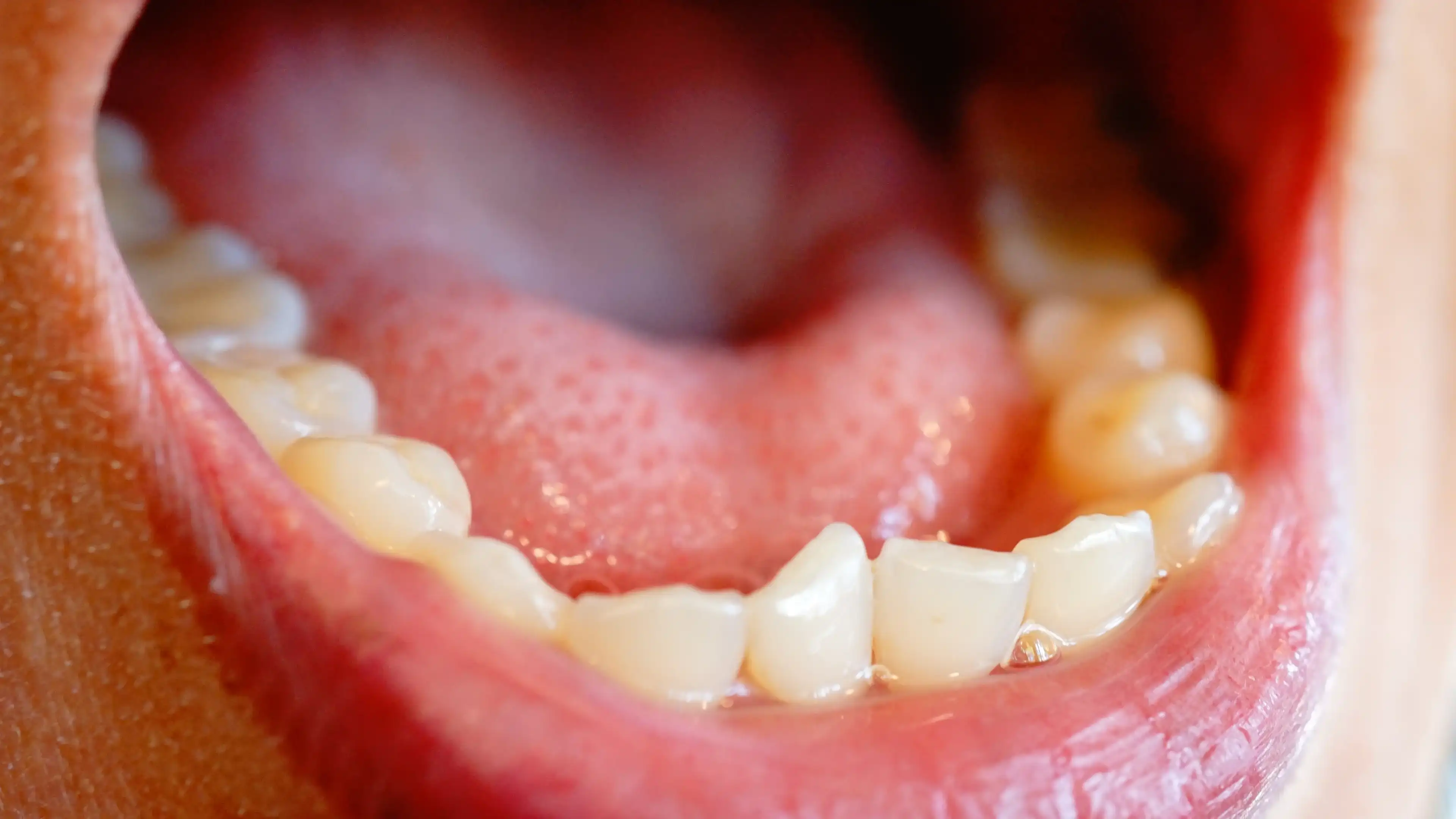 Snaggle tooth that may require treatment
