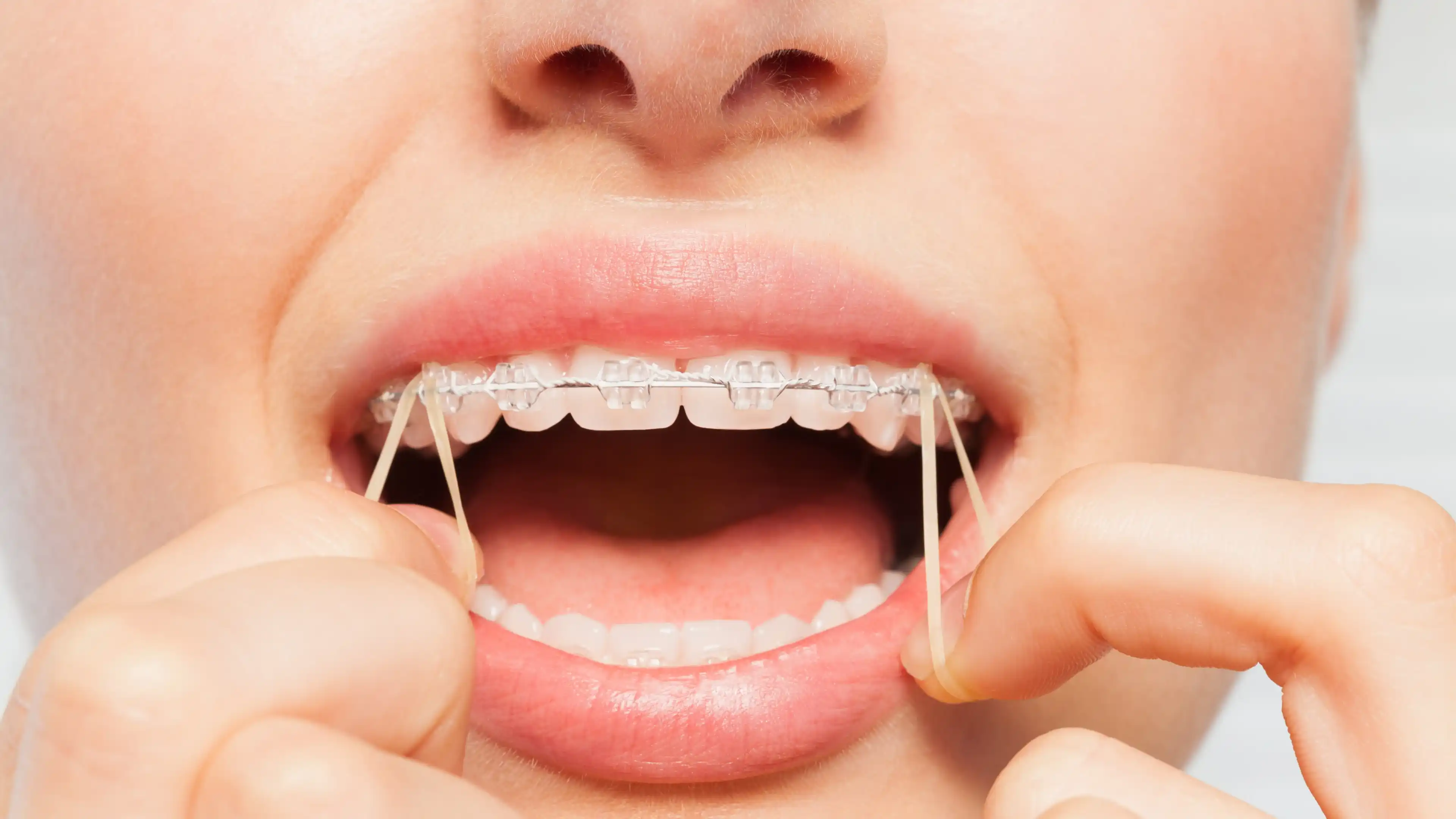 Braces correcting a snaggle tooth