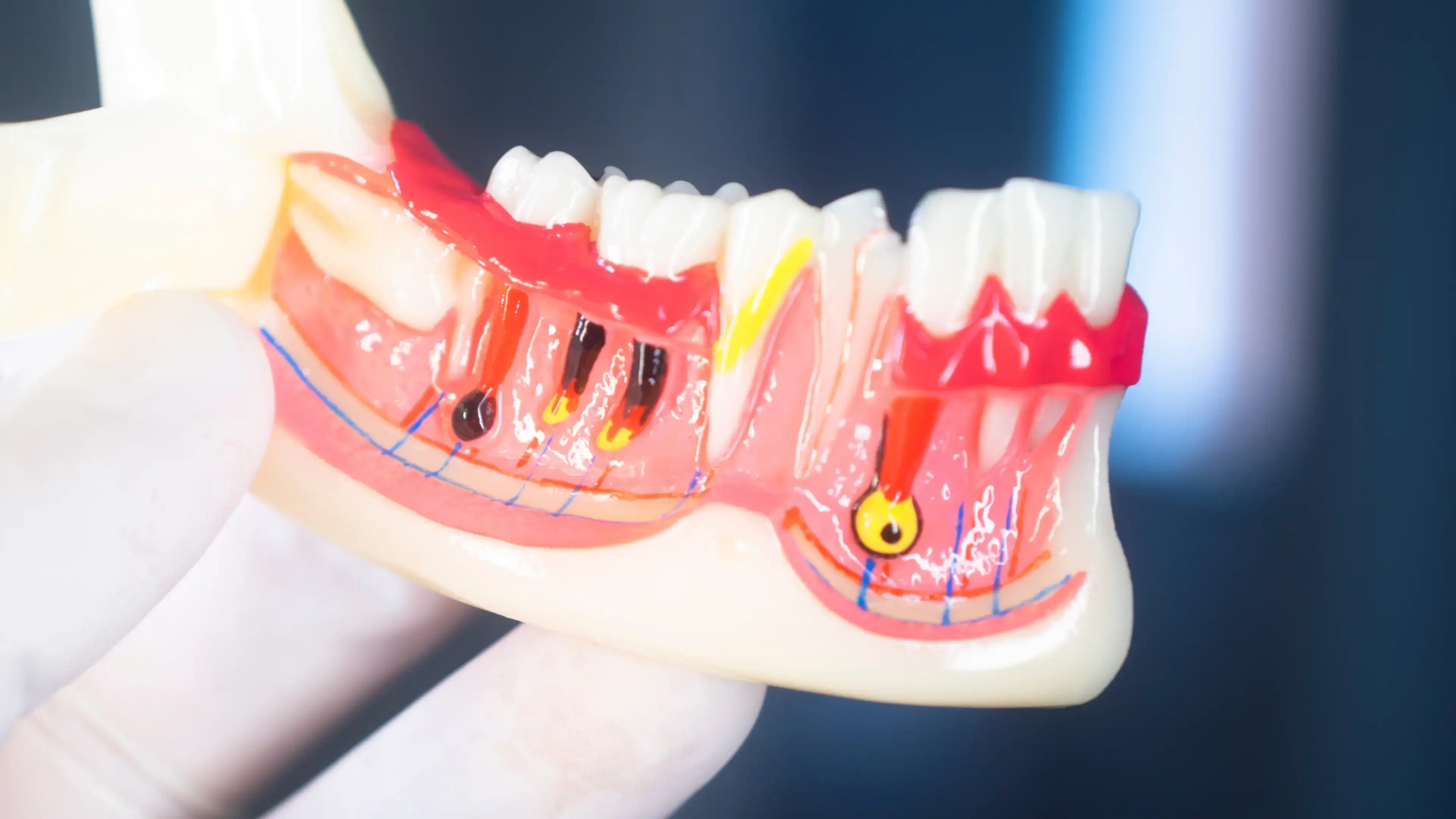 Model showing a tooth infection