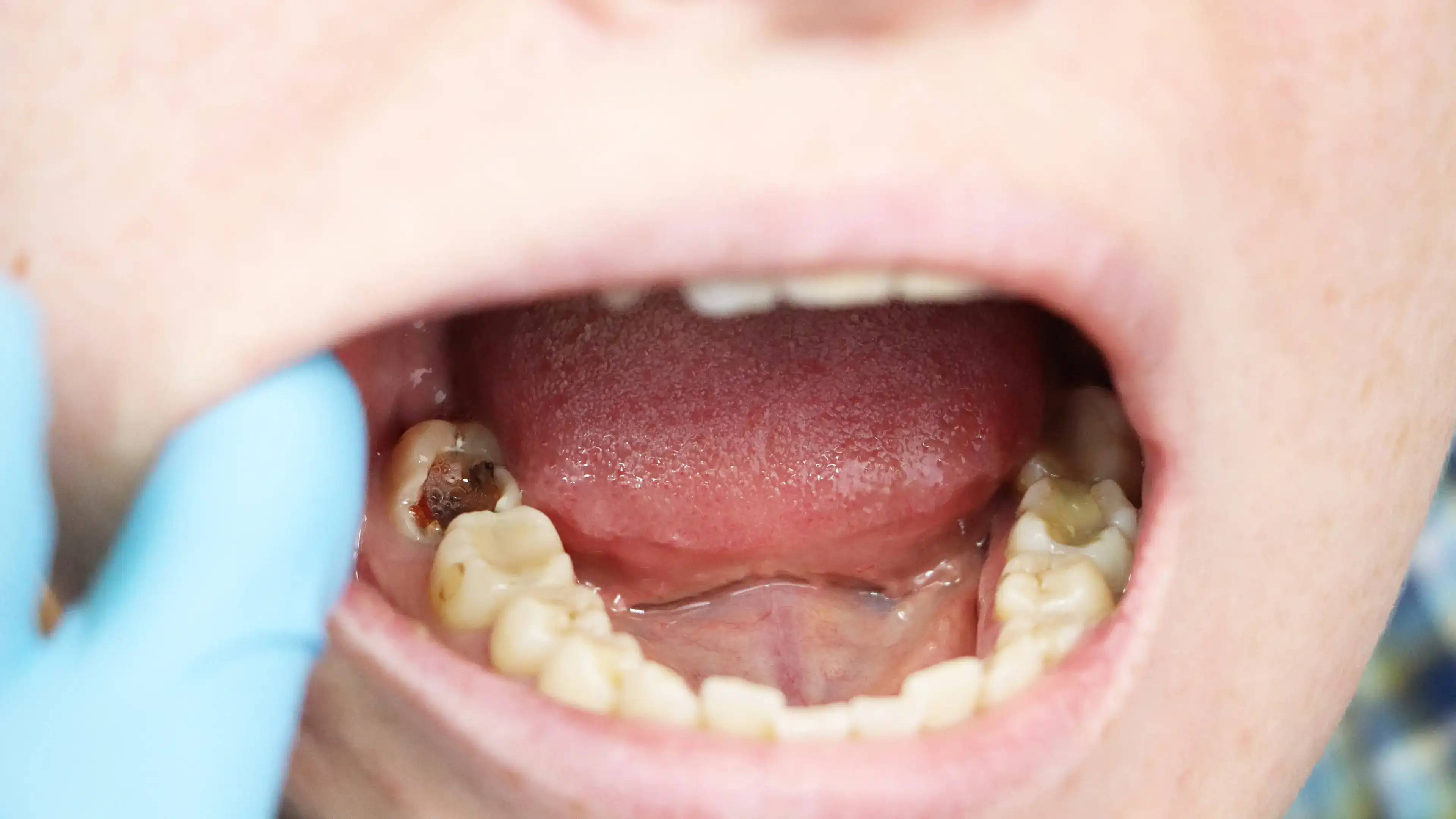Visible symptoms of tooth infection
