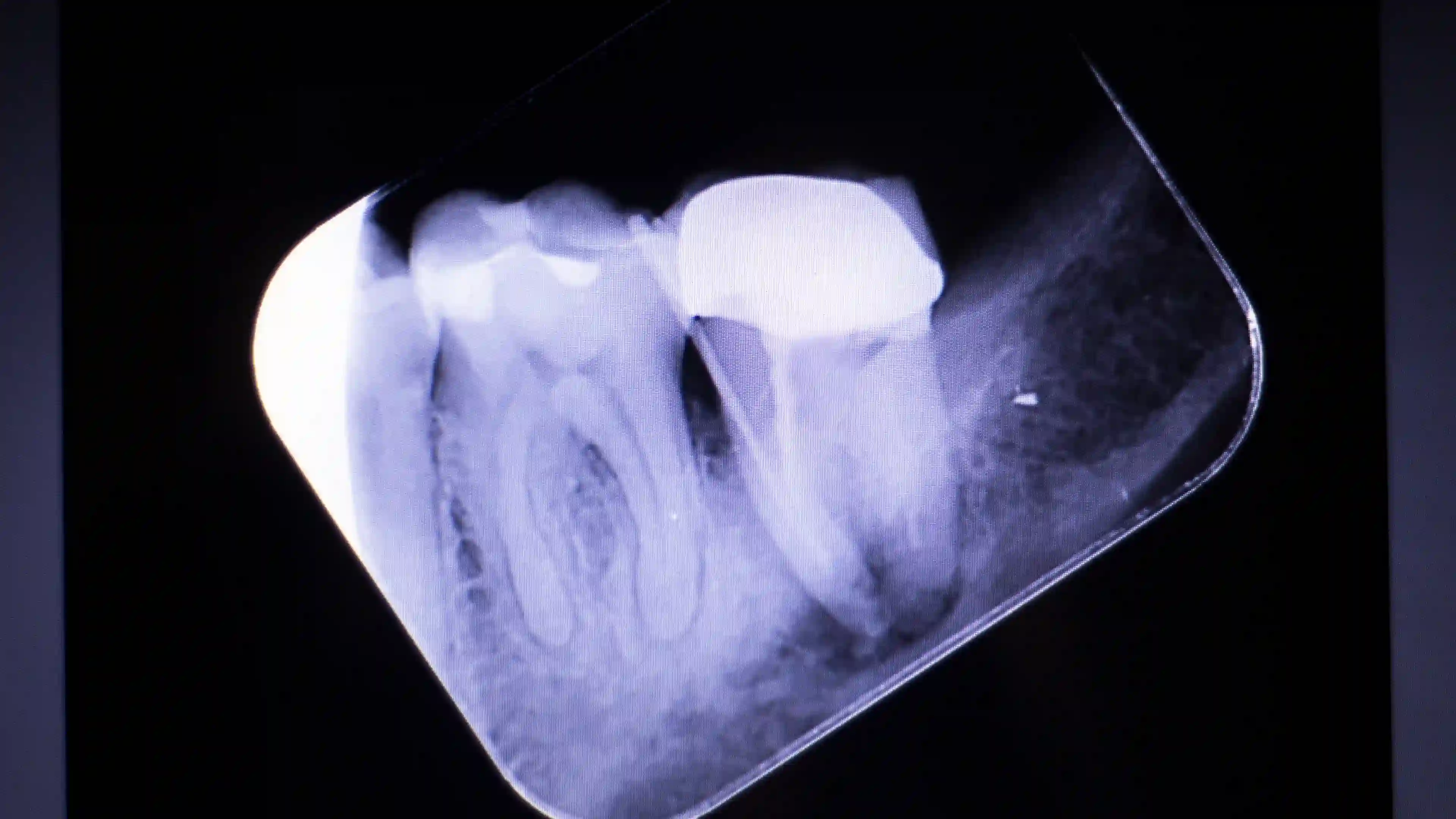 X-ray showing tooth root infection