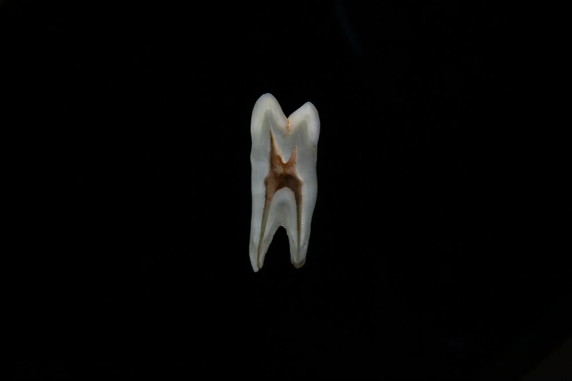 AI in root canal – detection of complex and hidden canals