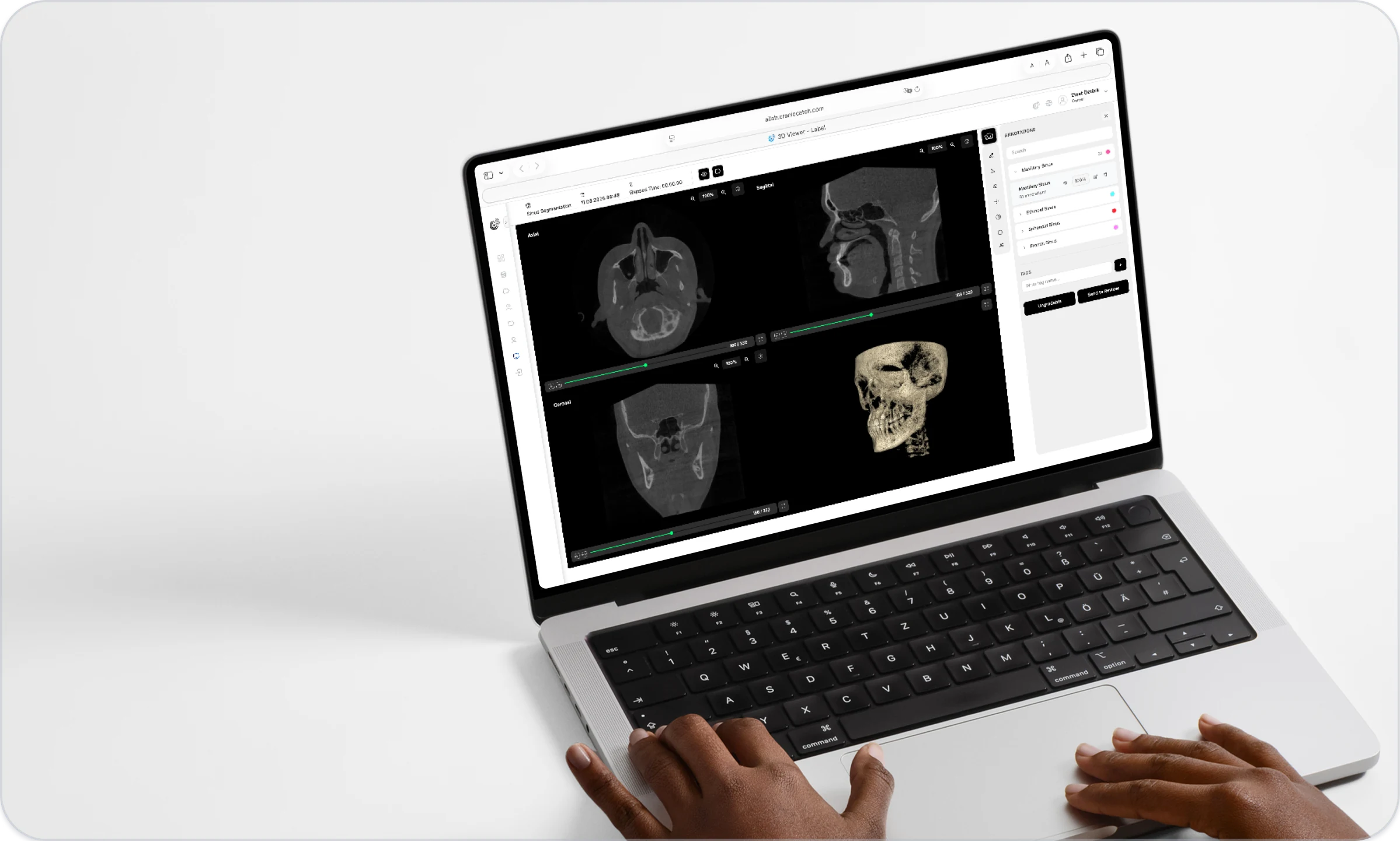 Radyografi üzerinde işaretlenmiş dental restorasyon etiketlerini içeren CranioCatch AILab etiket listesi