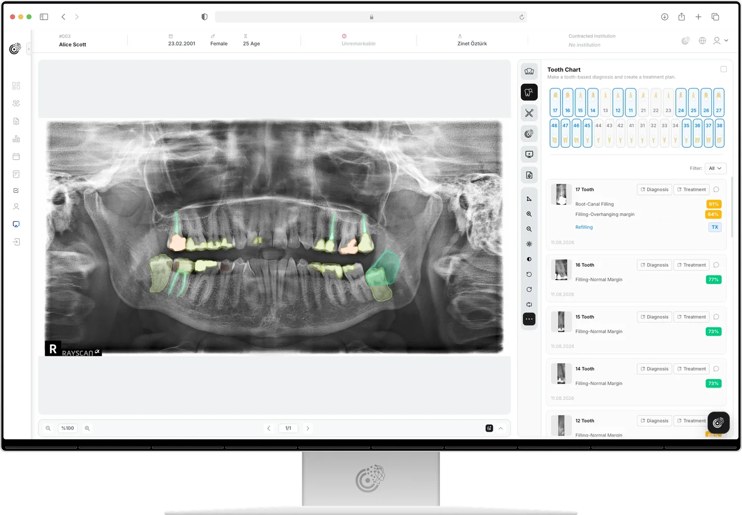 CranioCatch tarafından analiz edilen panoramik radyografi; bulgular işaretlenmiş ve diş şemasında listelenmiş