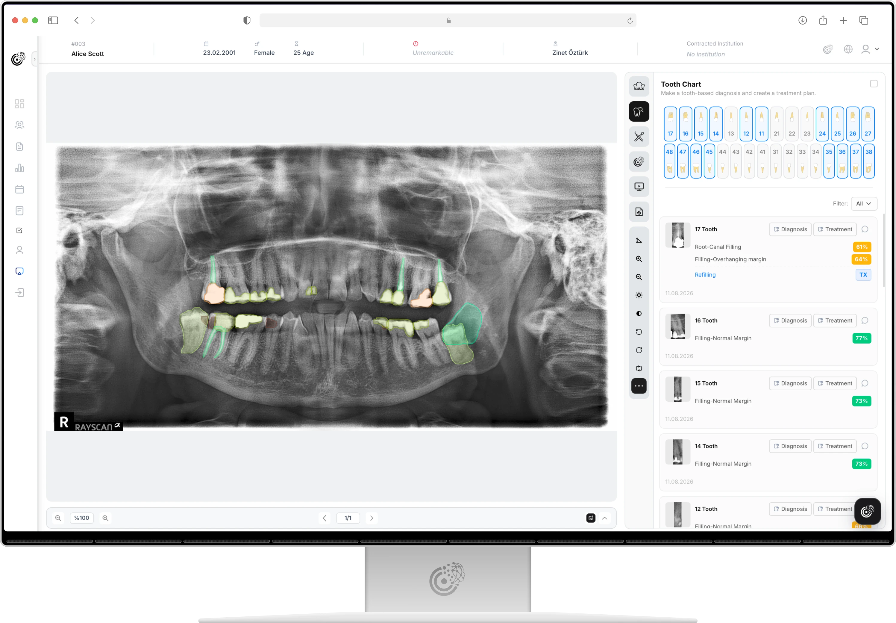 Panoramic radiograph analysed by CranioCatch, with findings marked and listed in a tooth chart