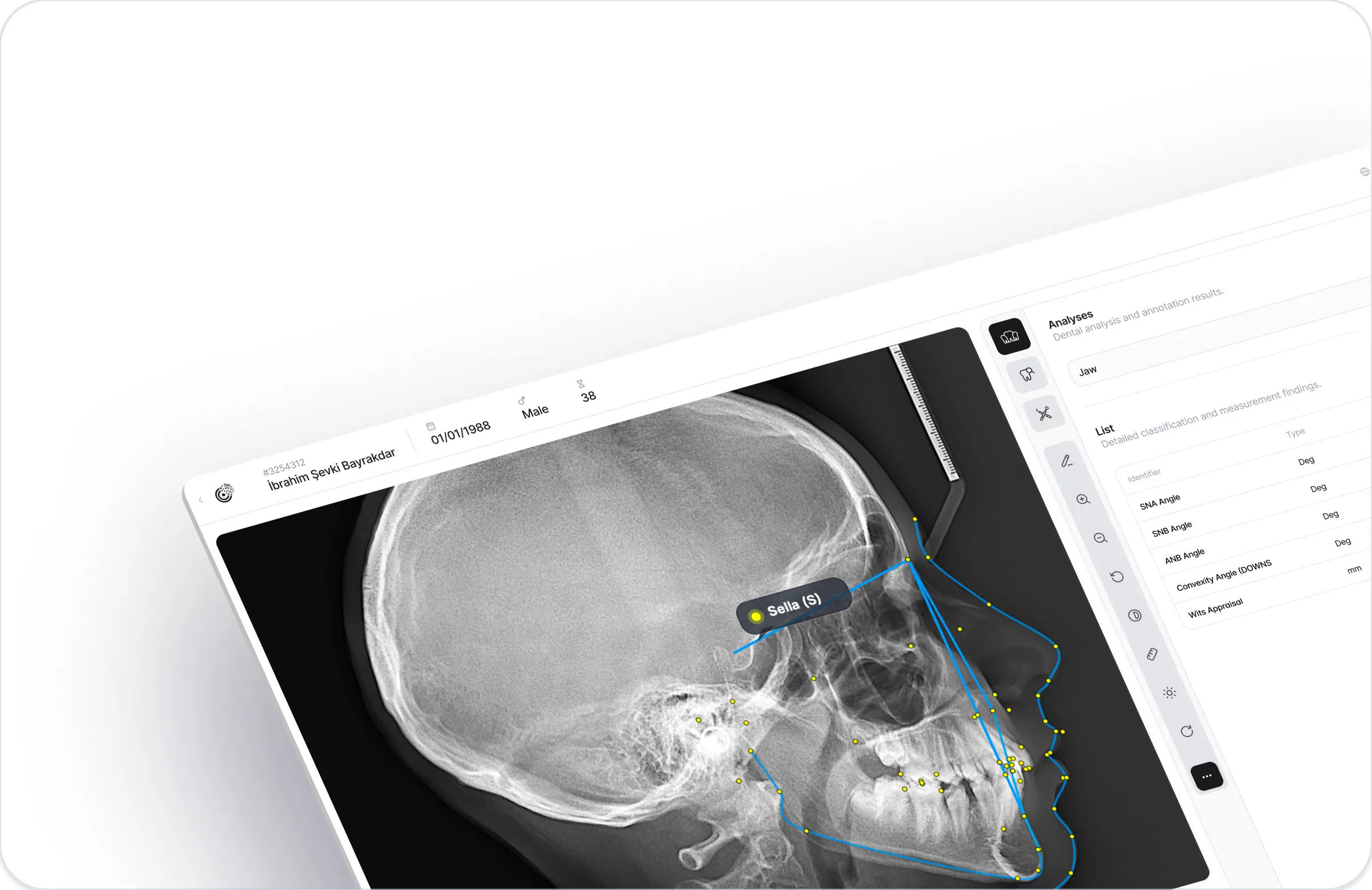 Çizimi tamamlanmış sefalometrik radyografinin yanındaki CranioCatch Angle Steiner analizi ölçüm tablosu