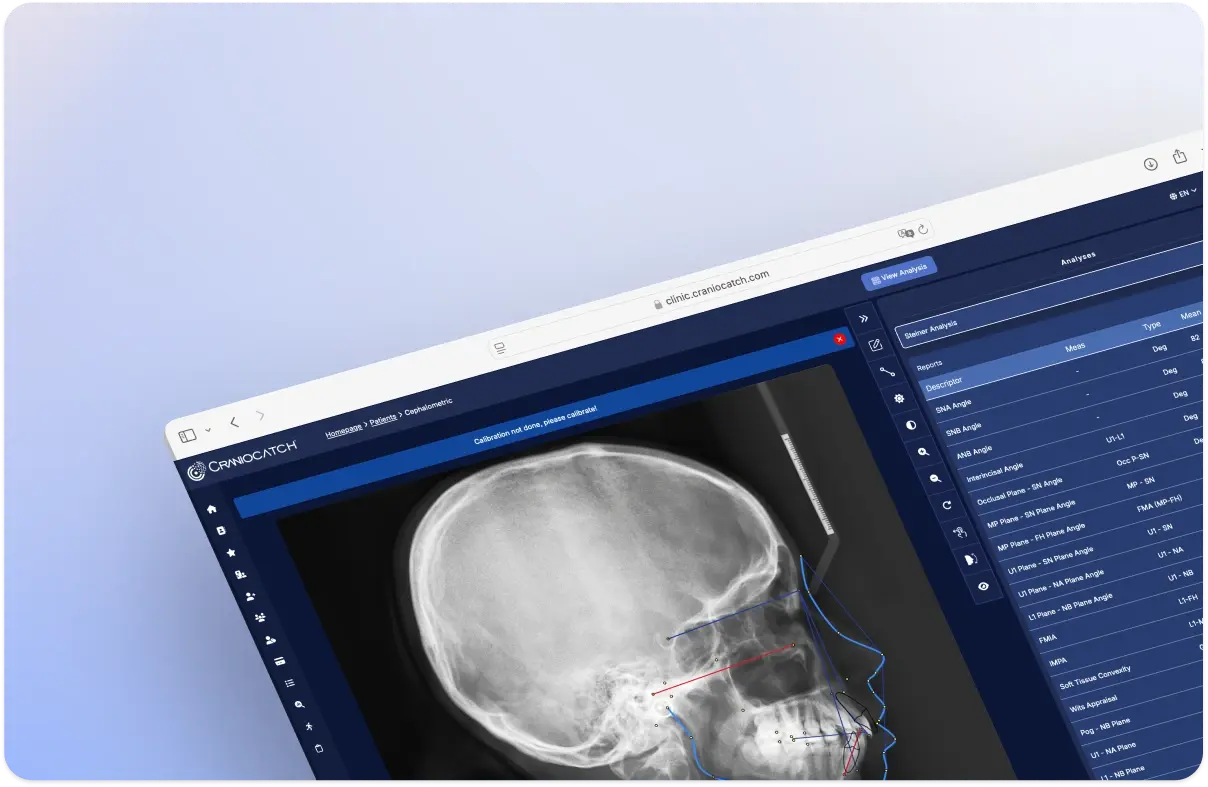Çizimi tamamlanmış sefalometrik radyografinin yanındaki CranioCatch Angle Steiner analizi ölçüm tablosu