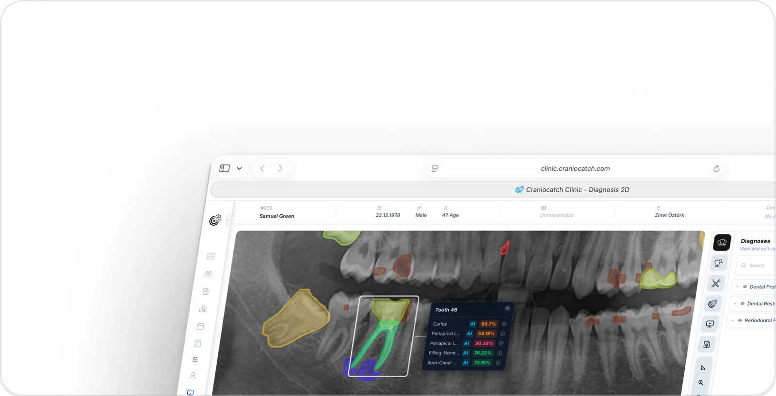 Panoramik radyografide tek bir diş için yapay zeka güven oranlarını listeleyen CranioCatch Clinic