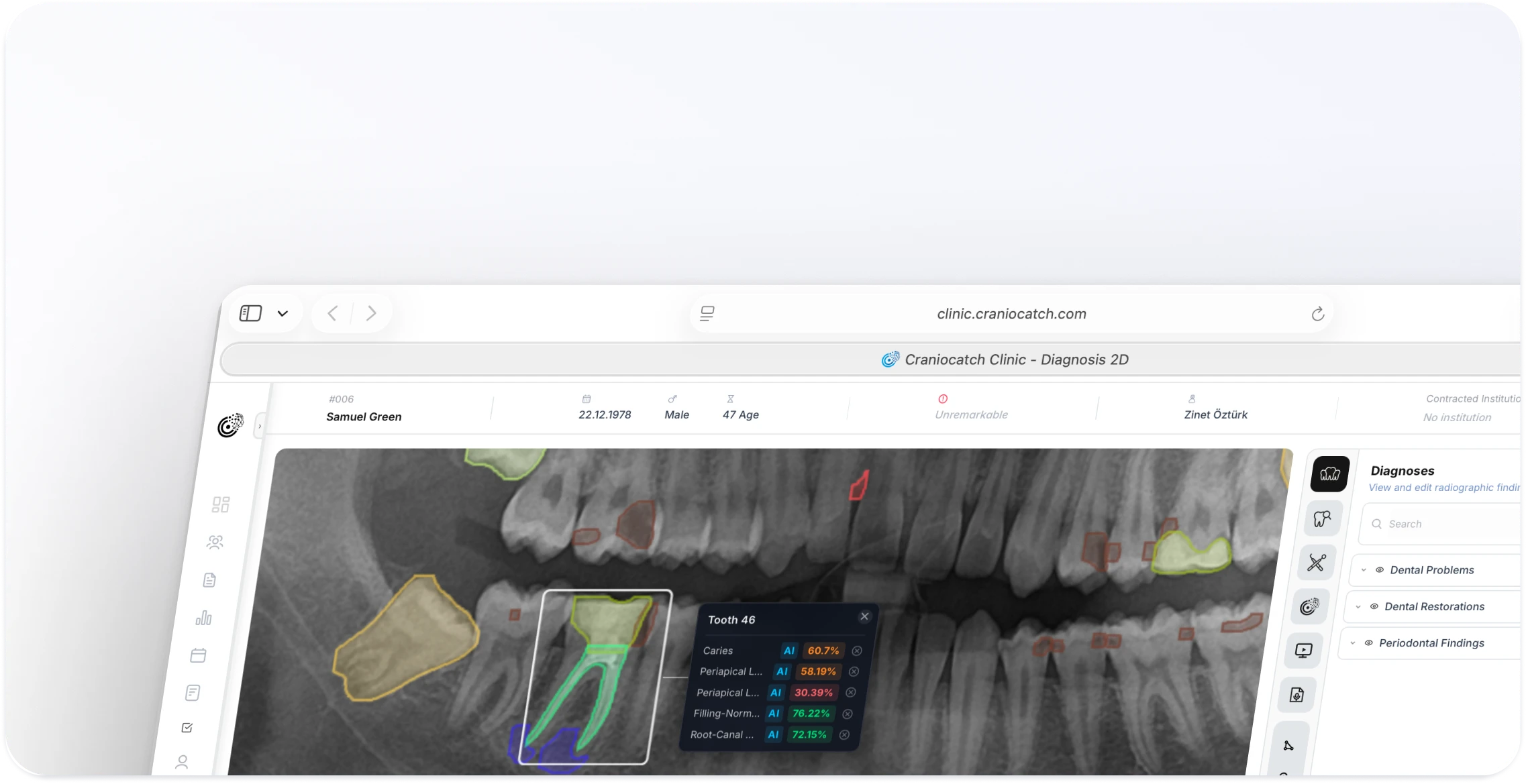 Panoramik radyografide tek bir diş için yapay zeka güven oranlarını listeleyen CranioCatch Clinic