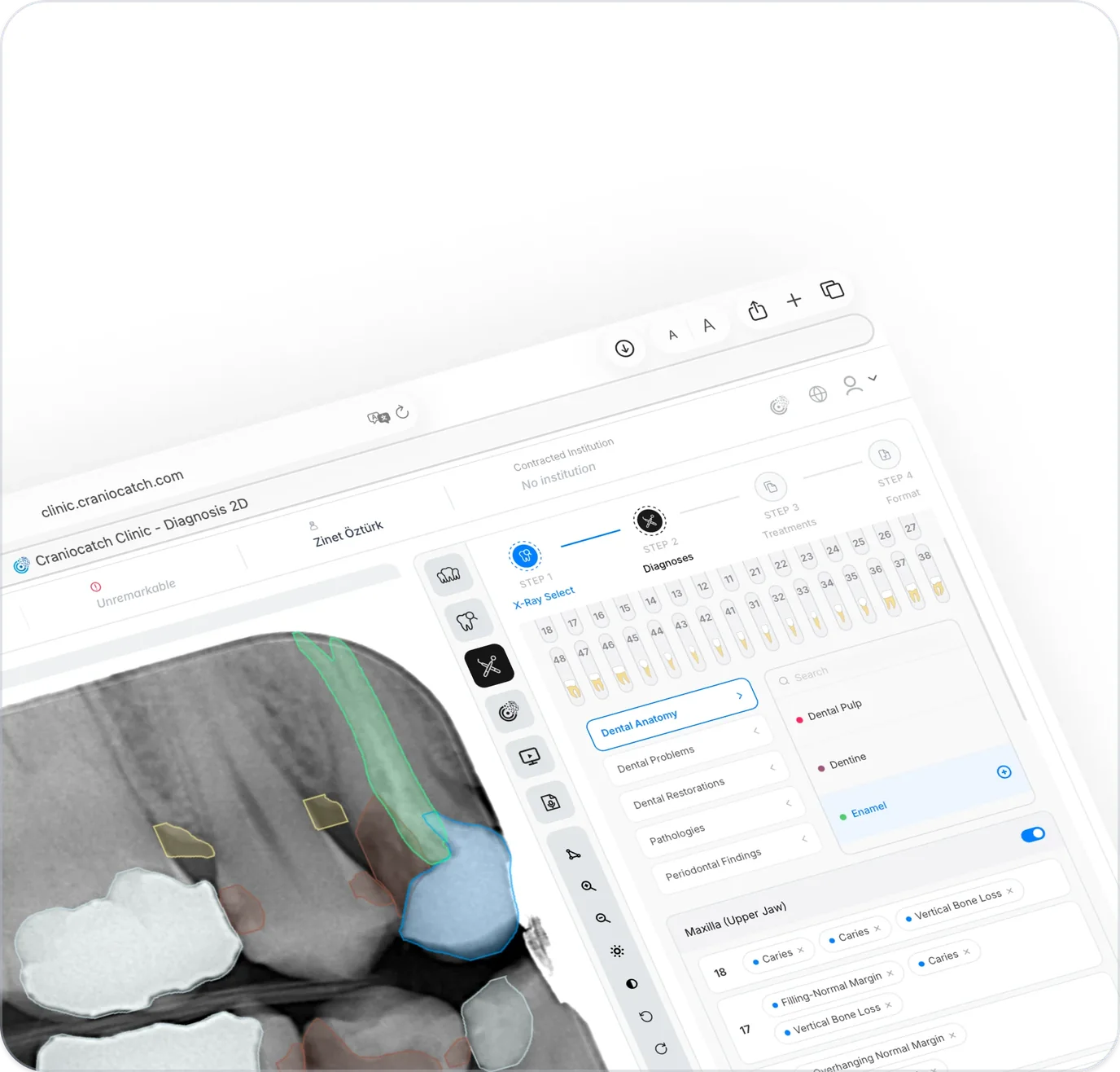 Periapikal radyografi üzerinde diş şeması ve bulgu listesi bulunan CranioCatch Clinic teşhis ekranı