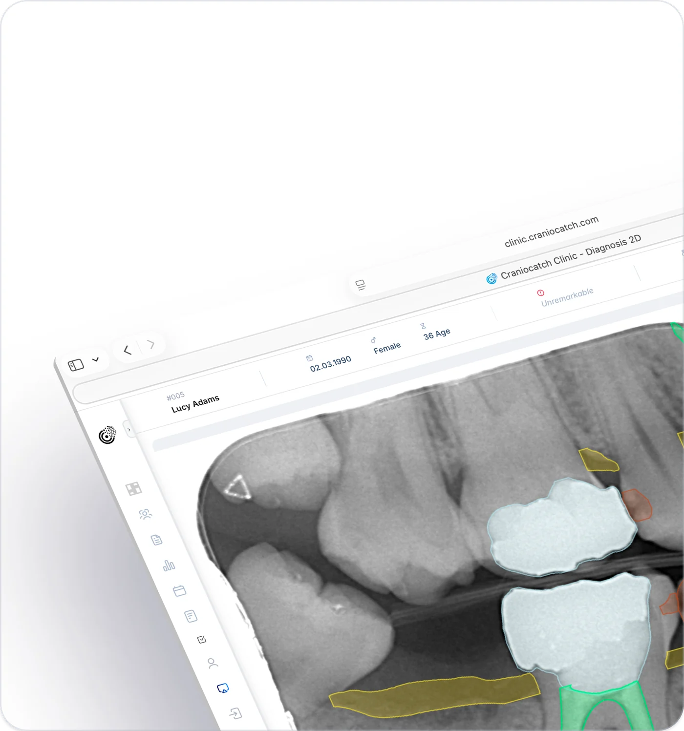 Tablette periapikal radyografi üzerinde çürük ve dolguları işaretleyen CranioCatch Clinic