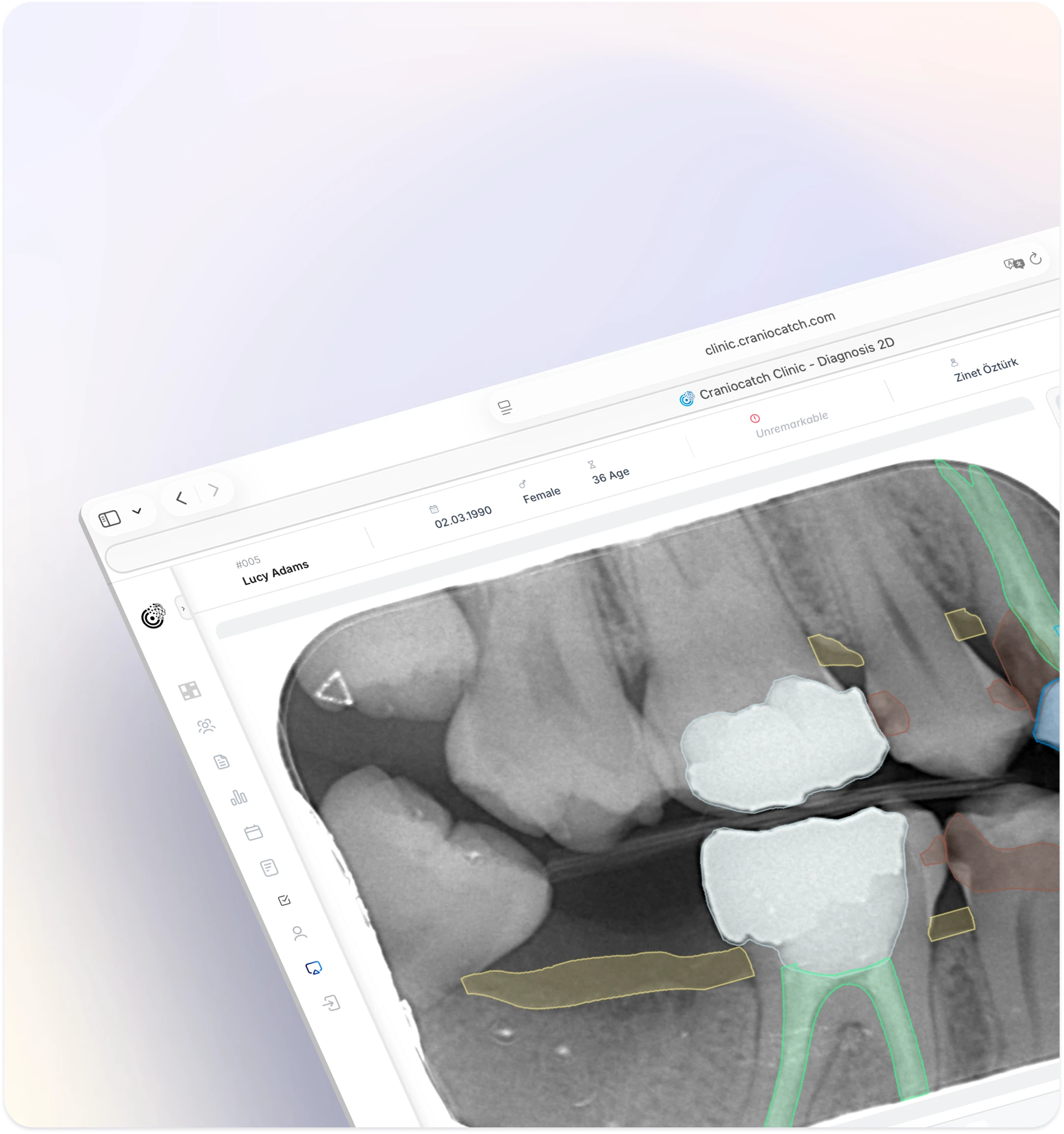 Tablette periapikal radyografi üzerinde çürük ve dolguları işaretleyen CranioCatch Clinic