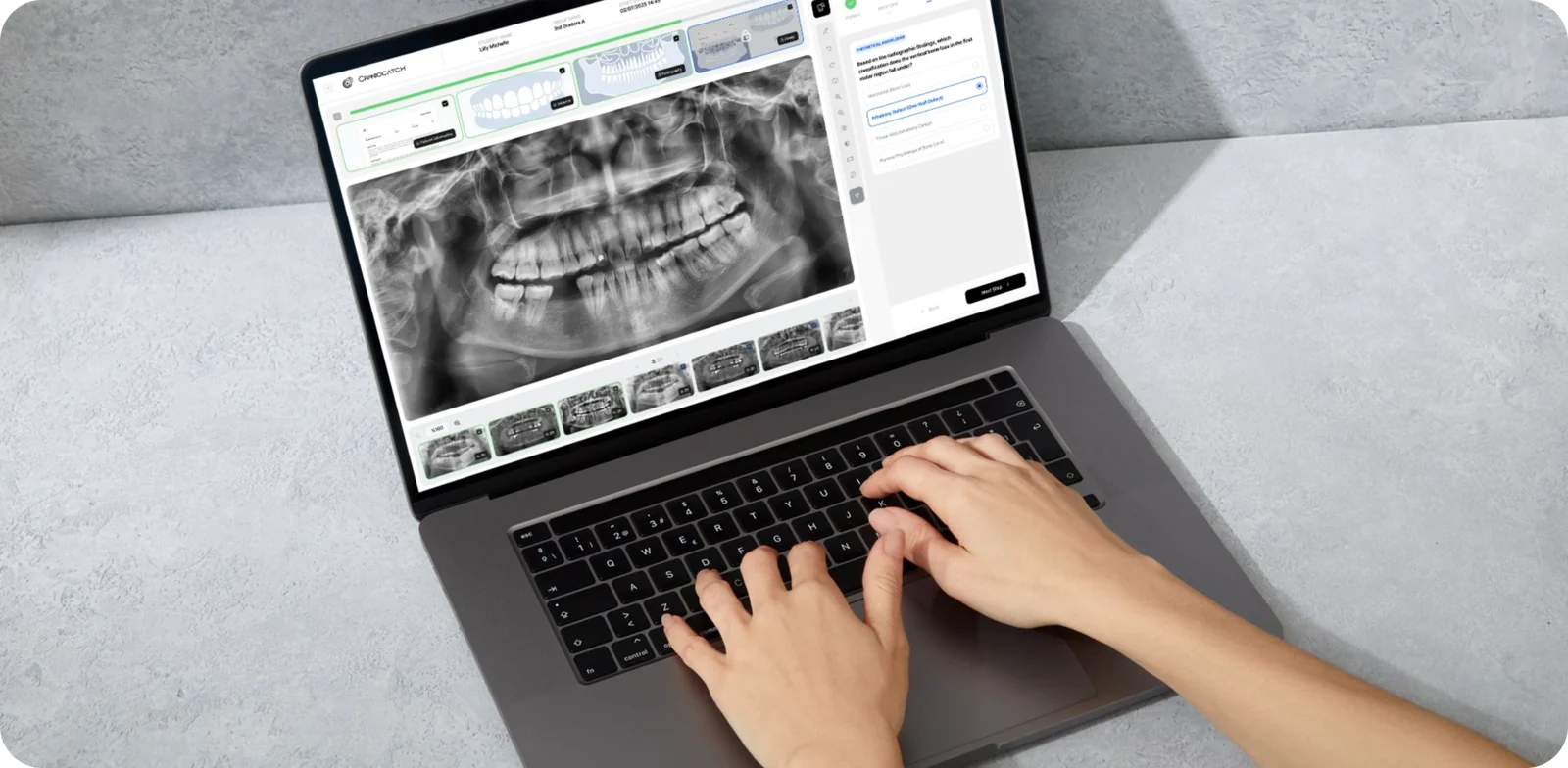 Üniversite bilgisayar laboratuvarında CranioCatch Edu üzerinde bitewing radyografi inceleyen diş hekimliği öğrencileri