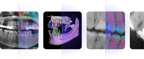 Yapay zeka bulguları renkli olarak işaretlenmiş panoramik, CBCT, bitewing ve periapikal radyografiler